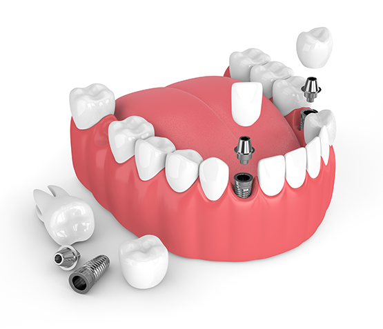 Example of Dental Implants
